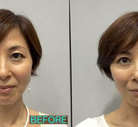 さなえ先生PJ施術前後比較