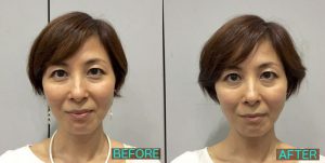 さなえ先生PJ施術前後比較