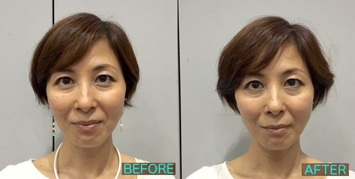 さなえ先生PJ施術前後比較