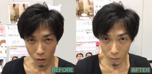 さなえ先生旦那様PJ施術前後比較