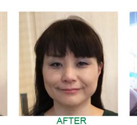 パワージュエル美容系施術前後比較