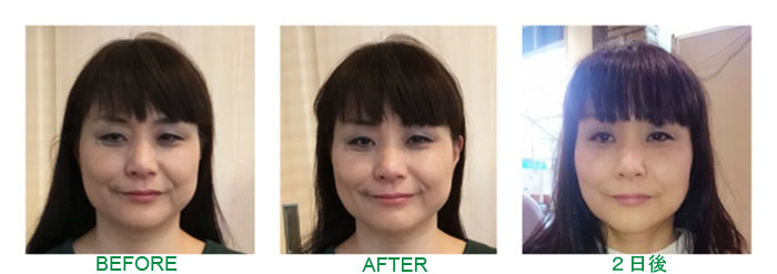 パワージュエル美容系施術前後比較