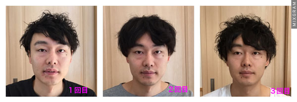 パワージュエルビフォーアフター男性の施術例