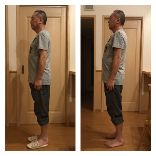 パワージュエルビフォーアフター横向き